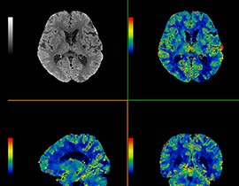 Ct Perfusion 4d Neuro Ge Healthcare Australia New Zealand